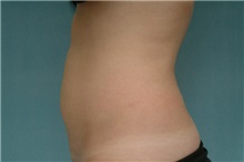 Liposuction Before Photo by Robert Zubowski, MD; Paramus, NJ - Case 23801