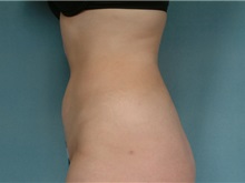 Liposuction After Photo by Robert Zubowski, MD; Paramus, NJ - Case 23802