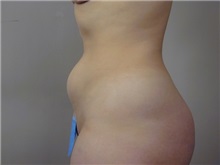Liposuction Before Photo by Robert Zubowski, MD; Paramus, NJ - Case 23802