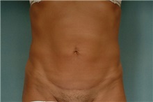 Liposuction After Photo by Robert Zubowski, MD; Paramus, NJ - Case 23804