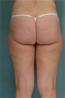 Liposuction Before Photo by Robert Zubowski, MD; Paramus, NJ - Case 23804