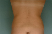 Liposuction After Photo by Robert Zubowski, MD; Paramus, NJ - Case 23805