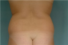 Liposuction Before Photo by Robert Zubowski, MD; Paramus, NJ - Case 23805