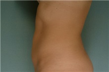 Liposuction After Photo by Robert Zubowski, MD; Paramus, NJ - Case 23805