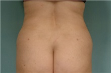 Liposuction After Photo by Robert Zubowski, MD; Paramus, NJ - Case 23806