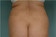 Liposuction Before Photo by Robert Zubowski, MD; Paramus, NJ - Case 23806