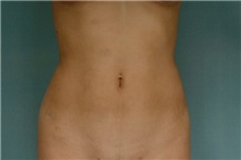 Liposuction After Photo by Robert Zubowski, MD; Paramus, NJ - Case 23807
