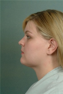Liposuction After Photo by Robert Zubowski, MD; Paramus, NJ - Case 23808