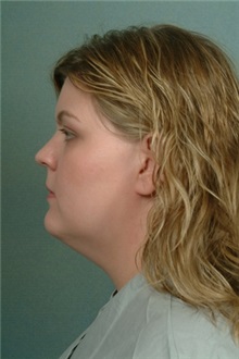 Liposuction Before Photo by Robert Zubowski, MD; Paramus, NJ - Case 23808