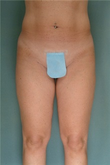 Liposuction After Photo by Robert Zubowski, MD; Paramus, NJ - Case 23809