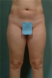Liposuction Before Photo by Robert Zubowski, MD; Paramus, NJ - Case 23809