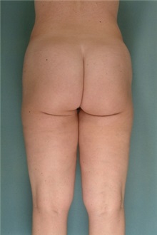 Liposuction After Photo by Robert Zubowski, MD; Paramus, NJ - Case 23809