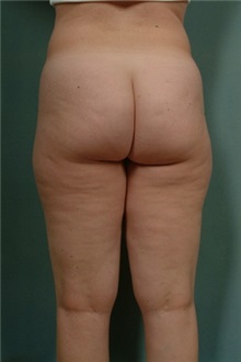 Liposuction Before Photo by Robert Zubowski, MD; Paramus, NJ - Case 23809