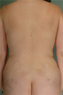 Liposuction After Photo by Robert Zubowski, MD; Paramus, NJ - Case 23812