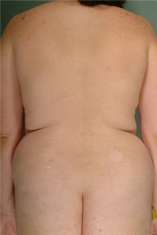 Liposuction Before Photo by Robert Zubowski, MD; Paramus, NJ - Case 23812