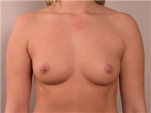 Breast Augmentation Before Photo by Robert Zubowski, MD; Paramus, NJ - Case 23821