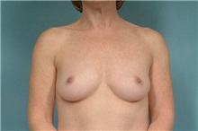 Breast Augmentation Before Photo by Robert Zubowski, MD; Paramus, NJ - Case 23823