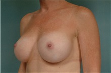 Breast Augmentation After Photo by Robert Zubowski, MD; Paramus, NJ - Case 23823
