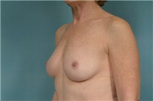 Breast Augmentation Before Photo by Robert Zubowski, MD; Paramus, NJ - Case 23823