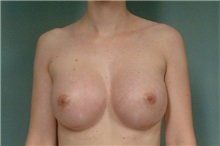 Breast Augmentation After Photo by Robert Zubowski, MD; Paramus, NJ - Case 23828