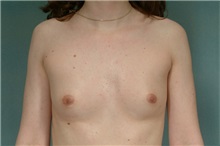 Breast Augmentation Before Photo by Robert Zubowski, MD; Paramus, NJ - Case 23828
