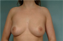 Breast Augmentation Before Photo by Robert Zubowski, MD; Paramus, NJ - Case 23829