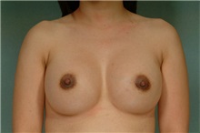 Breast Augmentation After Photo by Robert Zubowski, MD; Paramus, NJ - Case 23830