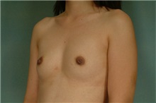 Breast Augmentation Before Photo by Robert Zubowski, MD; Paramus, NJ - Case 23830