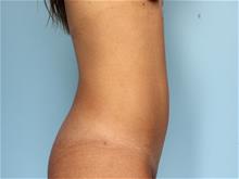 Liposuction After Photo by Robert Zubowski, MD; Paramus, NJ - Case 29070