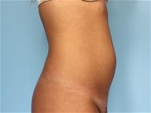 Liposuction Before Photo by Robert Zubowski, MD; Paramus, NJ - Case 29070