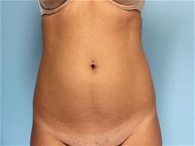 Liposuction Before Photo by Robert Zubowski, MD; Paramus, NJ - Case 29070