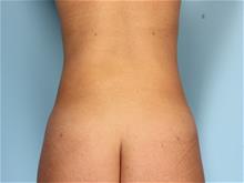Liposuction After Photo by Robert Zubowski, MD; Paramus, NJ - Case 29070
