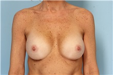 Breast Augmentation After Photo by Robert Zubowski, MD; Paramus, NJ - Case 33369