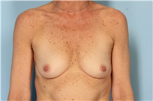 Breast Augmentation Before Photo by Robert Zubowski, MD; Paramus, NJ - Case 33369