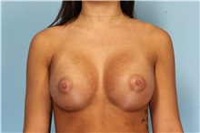 Breast Augmentation After Photo by Robert Zubowski, MD; Paramus, NJ - Case 33370