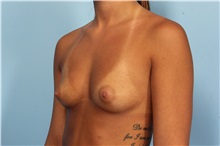 Breast Augmentation Before Photo by Robert Zubowski, MD; Paramus, NJ - Case 33370