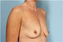Breast Augmentation Before Photo by Robert Zubowski, MD; Paramus, NJ - Case 33377