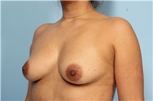Breast Augmentation Before Photo by Robert Zubowski, MD; Paramus, NJ - Case 33378