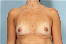 Breast Augmentation Before Photo by Robert Zubowski, MD; Paramus, NJ - Case 33381