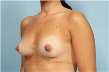 Breast Augmentation Before Photo by Robert Zubowski, MD; Paramus, NJ - Case 33381