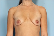 Breast Augmentation Before Photo by Robert Zubowski, MD; Paramus, NJ - Case 33383