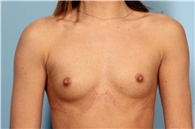 Breast Augmentation Before Photo by Robert Zubowski, MD; Paramus, NJ - Case 33384