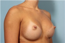 Breast Augmentation After Photo by Robert Zubowski, MD; Paramus, NJ - Case 33384