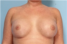 Breast Augmentation After Photo by Robert Zubowski, MD; Paramus, NJ - Case 33386