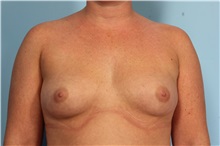 Breast Augmentation Before Photo by Robert Zubowski, MD; Paramus, NJ - Case 33386