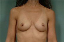 Breast Augmentation Before Photo by Robert Zubowski, MD; Paramus, NJ - Case 33391