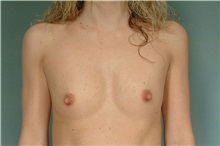 Breast Augmentation Before Photo by Robert Zubowski, MD; Paramus, NJ - Case 33392