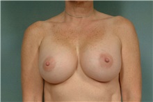 Breast Augmentation After Photo by Robert Zubowski, MD; Paramus, NJ - Case 33393