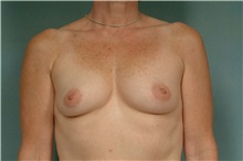 Breast Augmentation Before Photo by Robert Zubowski, MD; Paramus, NJ - Case 33393