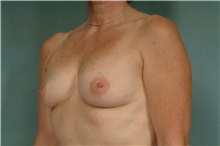 Breast Augmentation Before Photo by Robert Zubowski, MD; Paramus, NJ - Case 33393